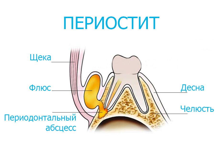 Почему возникает флюс после удаления зуба мудрости?