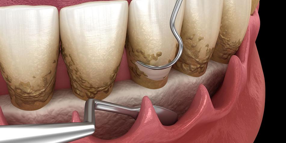 Кюретаж пародонтальных карманов в стоматологии.
