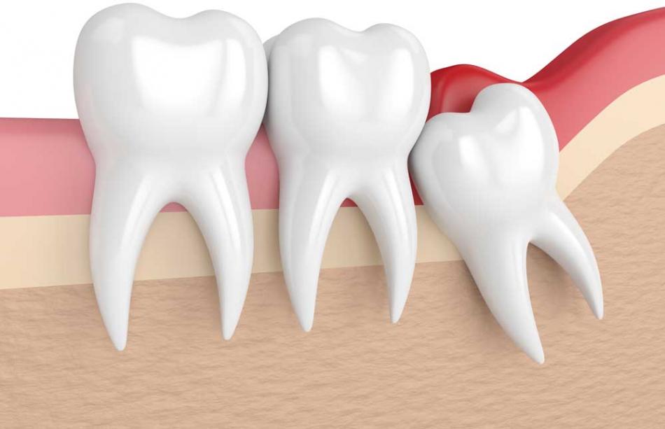 Зуб мудрости: причины прорезывания восьмерки.