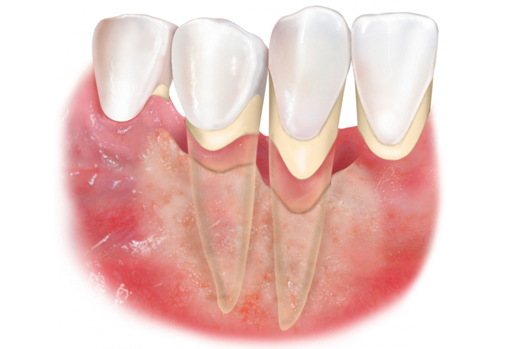 Виды пародонтита и способы лечения.