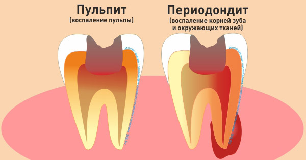 лечение пульпита у детей